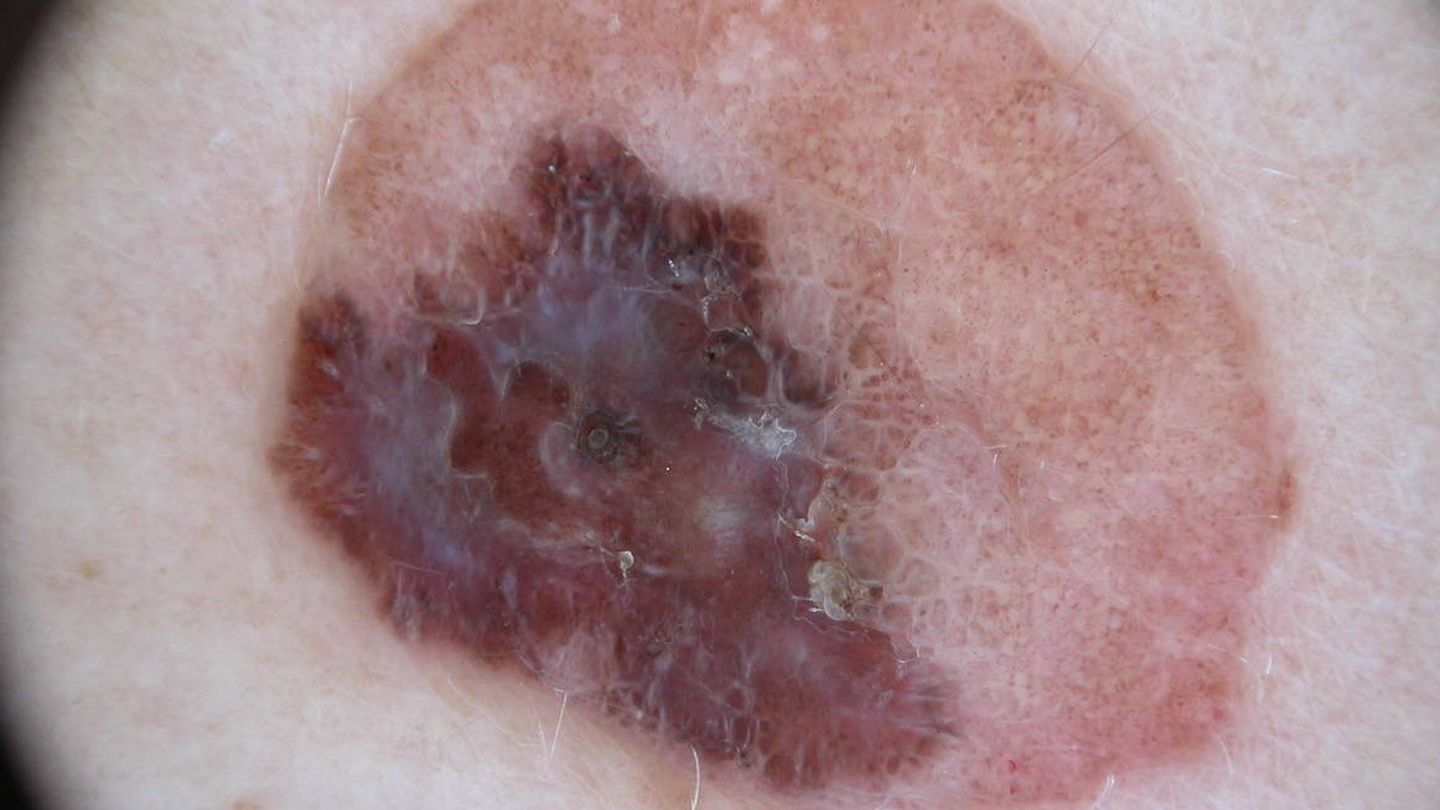 Imagen de un melanoma proporcionada por Silvestre Martín.