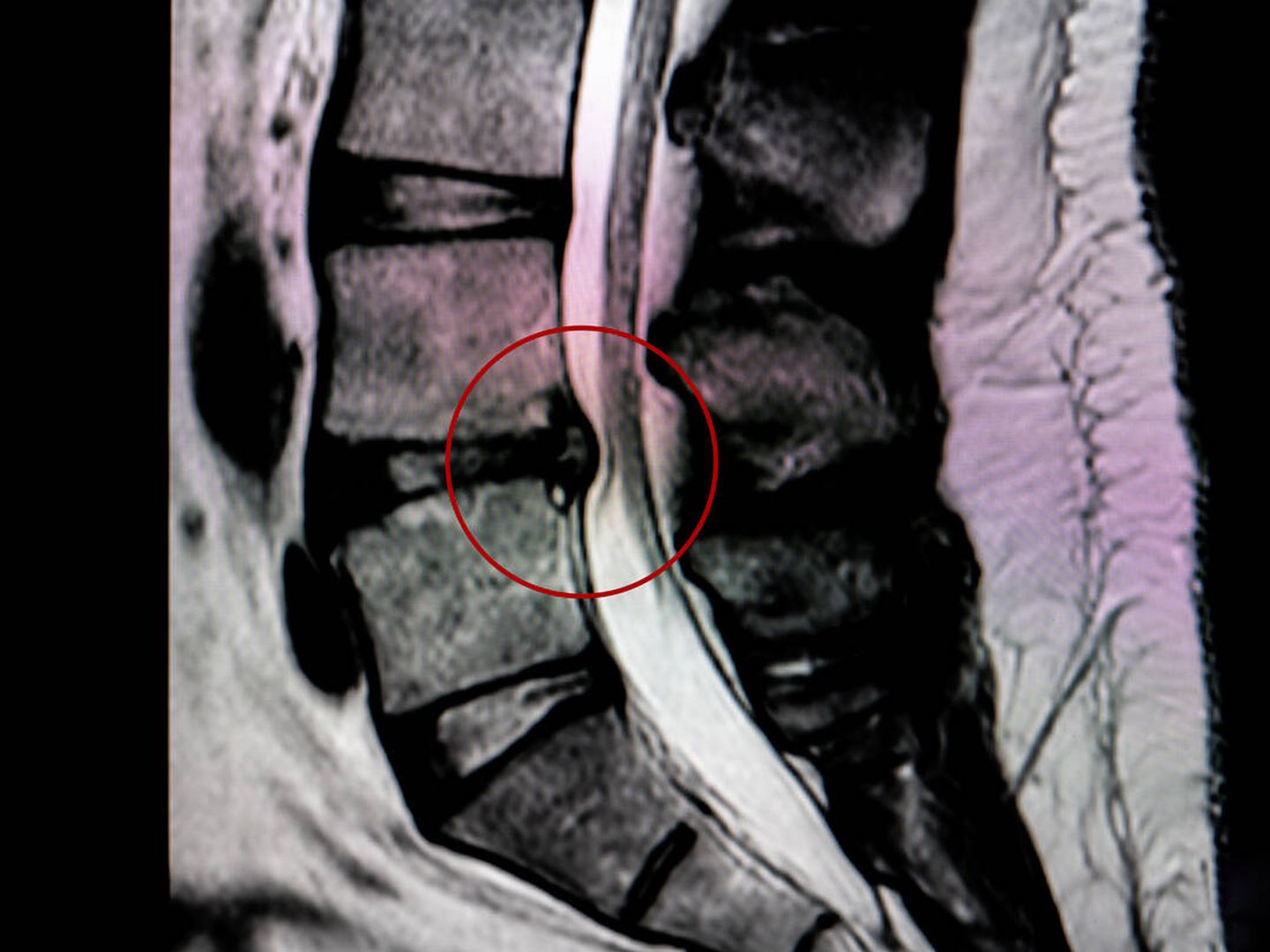La resonancia magnética muestra una hernia entre las vértebras lumbares 4 y 5 (Foto: iStock)