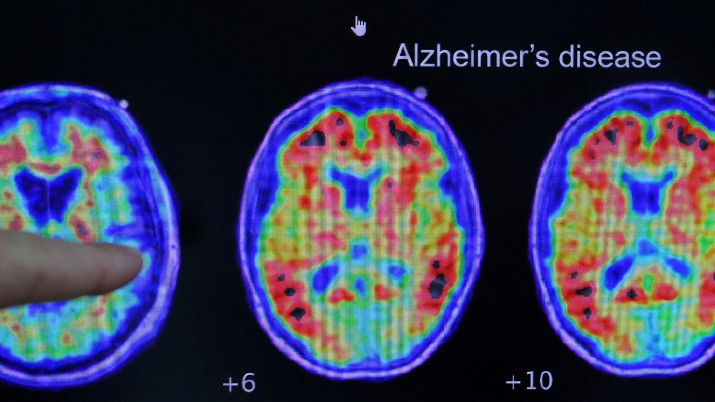 Un doctor señala escáneres del cerebro de un paciente con alzhéimer (Reuters)
