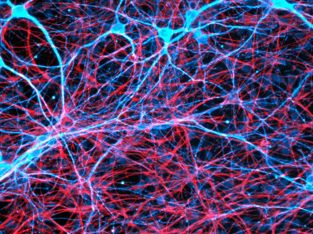 Умершие клетки мозга. Нейронная сеть мозга. Клетки головного мозга. Нейронные связи в мозге. Нервные клетки мозга.
