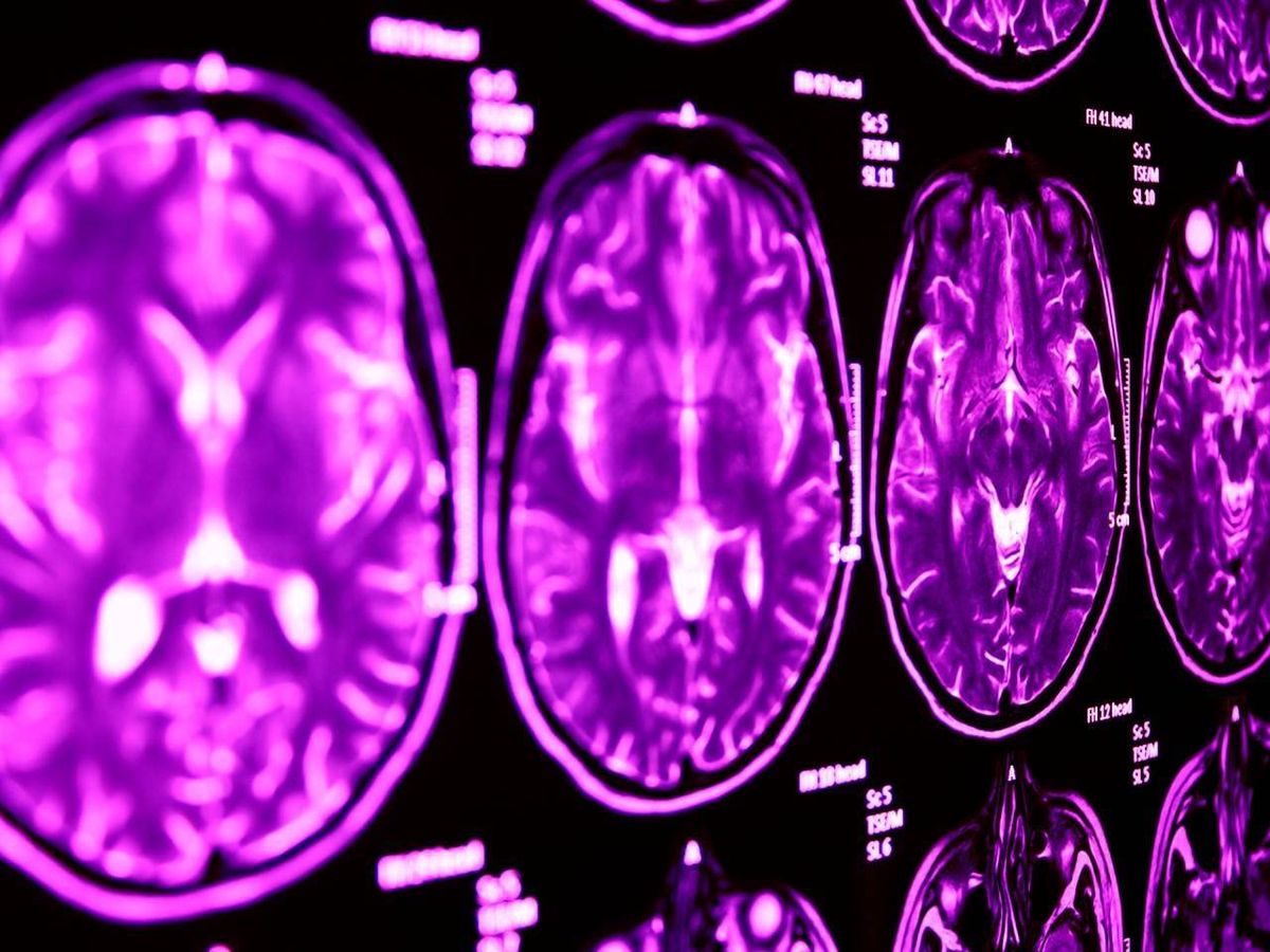 Foto: Resonancia magnética cerebral. Foto: Lancaster University