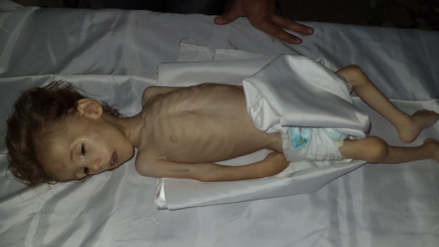 Un niño de muy corta edad desnutrido en Muadimiya (D. al Qappani). 