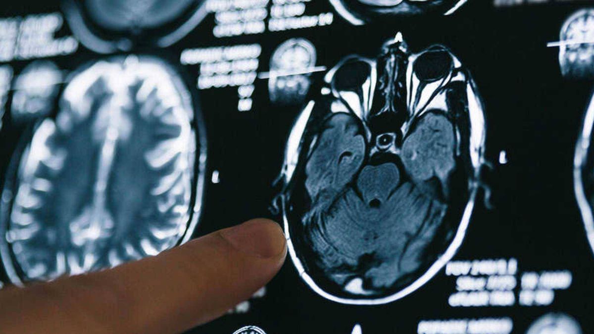 Una mutación 'blinda' el cerebro frente al alzhéimer y abre el camino a su tratamiento