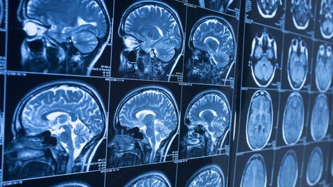 Un golpe en la cabeza puede aumentar el riesgo de Parkinson