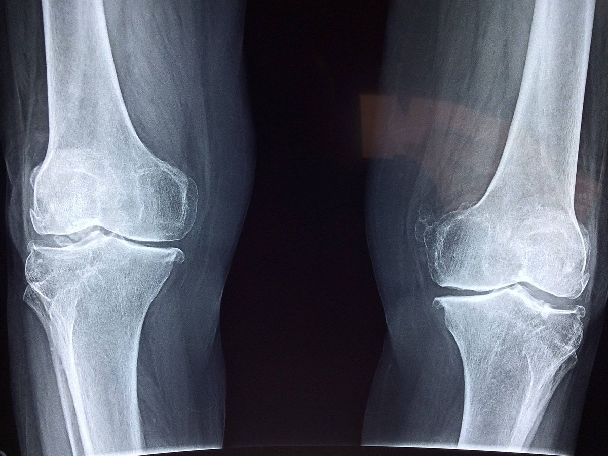 Foto: Una radiografía de la rodilla. Foto: Pixabay