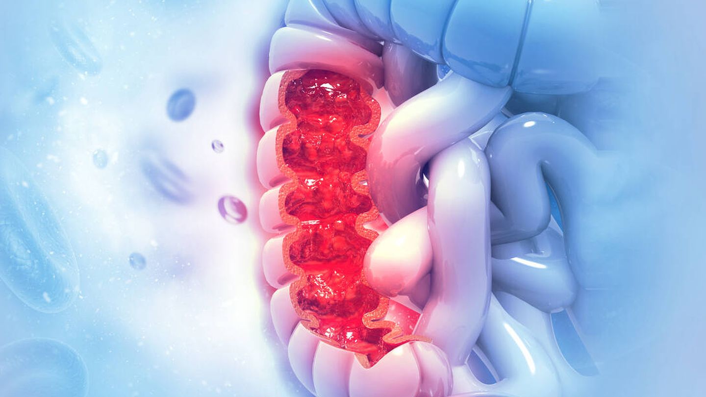 Imagen 3D de cáncer de colon. (iStock)