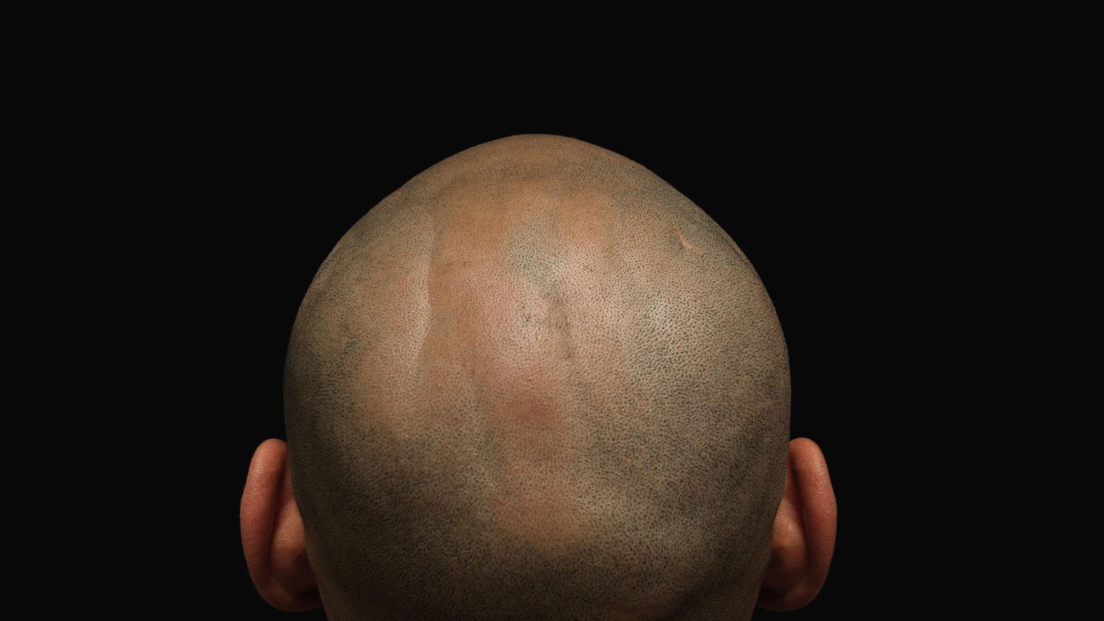 Foto: La alopecia también preocupa a las mujeres (Corbis)
