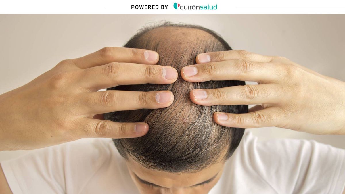 Un estudio analiza la relación entre la alopecia masculina y el coronavirus