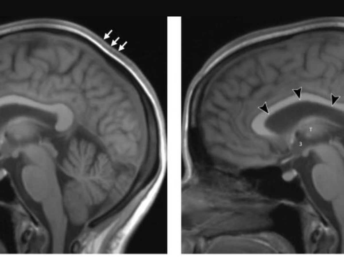 Foto: El cerebro de un astronauta, antes y después de una larga estancia en el espacio. Foto: Radiological Society of North America