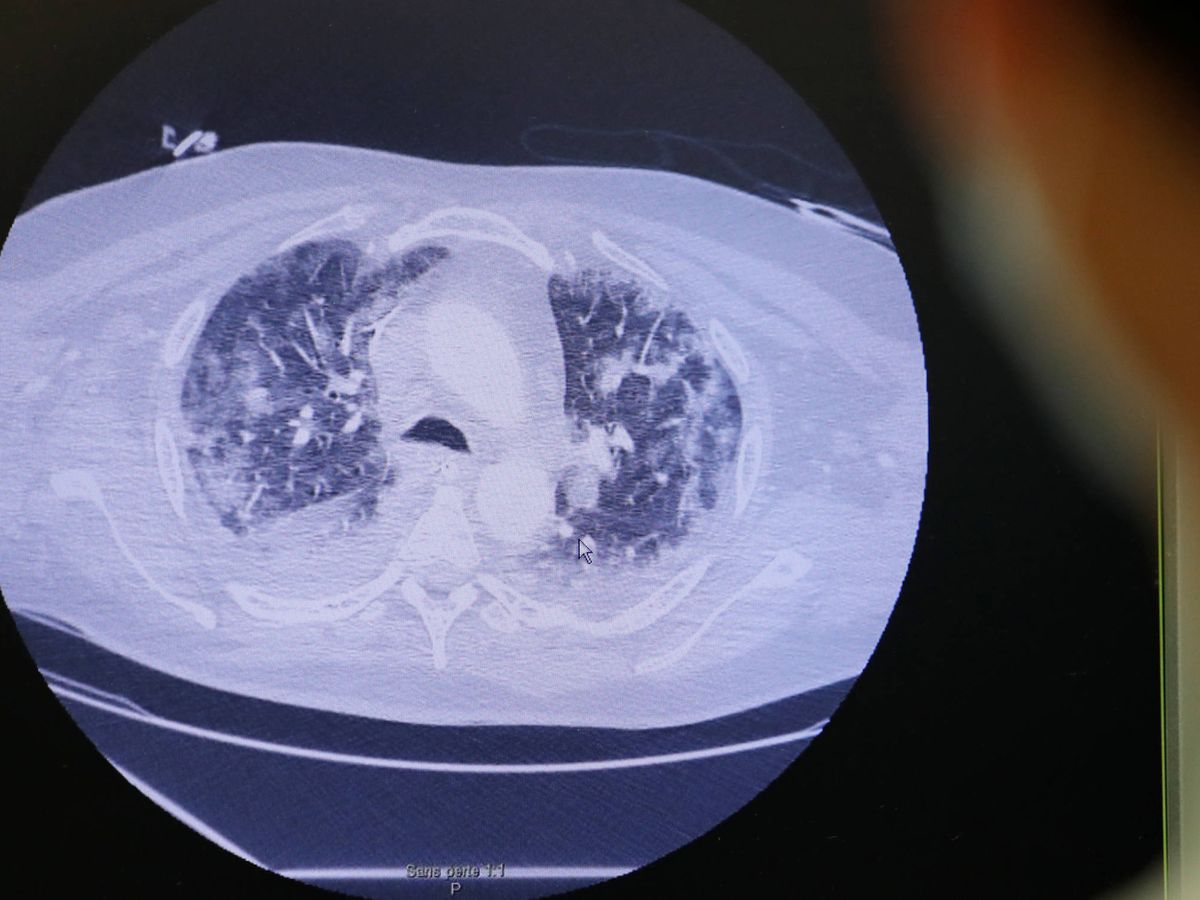 Foto: Escáner de los pulmones de un paciente de covid-19 en Vannes, Francia. (Reuters)