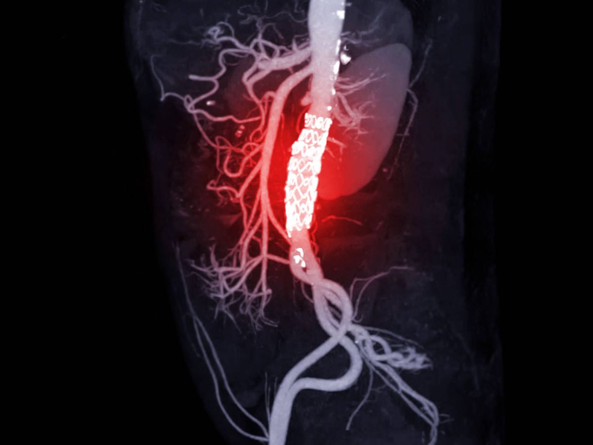 Foto: CTA de la aorta abdominal. (iStock)