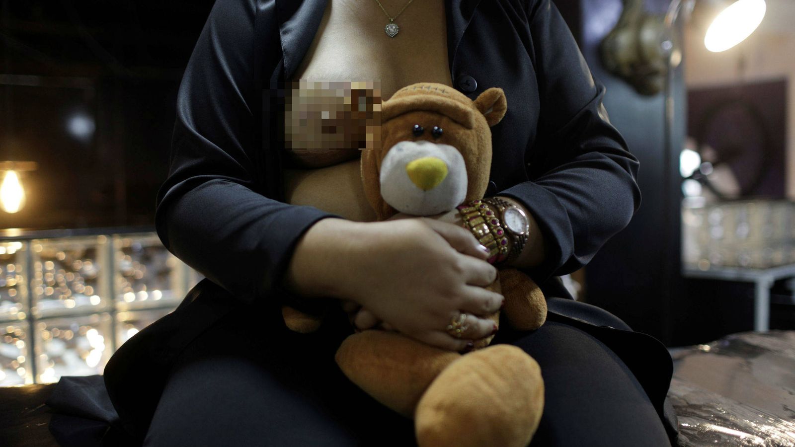 Foto: Una paciente después de ser operada por un cáncer de mama. (Reuters)