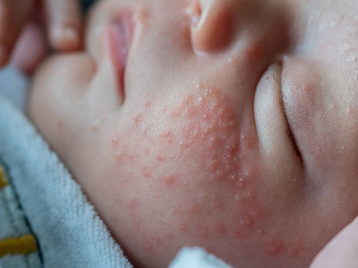 Foto: Bebé con placas de dermatitis atópica. (iStock)