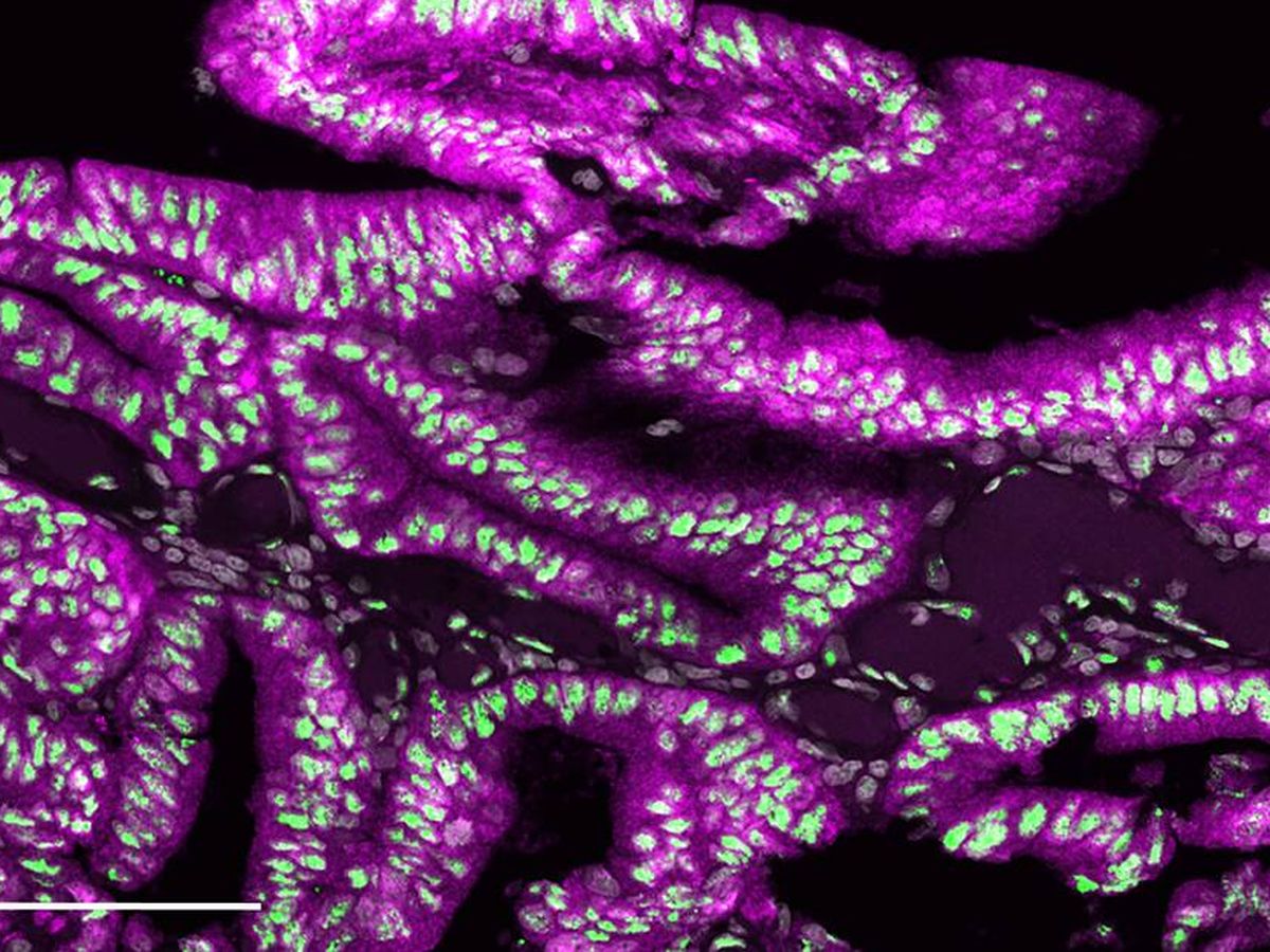 Foto: Imagen de inmunofluorescencia multiplex de cáncer colorrectal serrado humano rico en colesterol. (Anxo Martínez-Ordoñez)