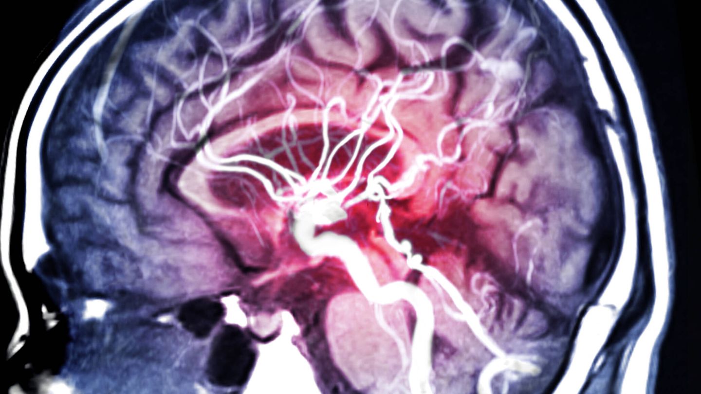 Angiografia cerebral por resonancia magnética. (iStock)