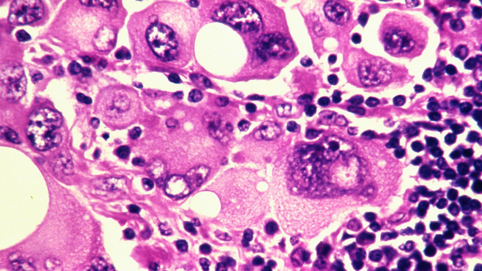 Foto: Células de melanoma humano (Foto: Corbis)