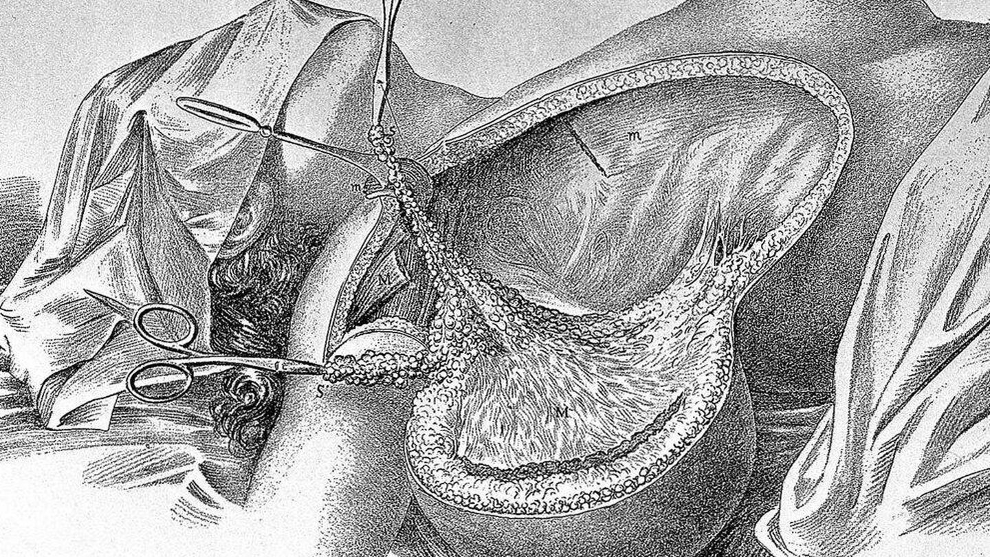 Ilustración de una mastectomía realizada por el médico William Stewart Halsted.