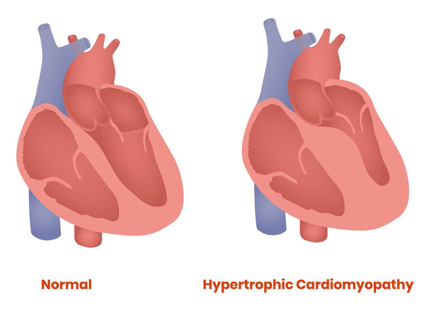 La hipertrofia ventricular izquierda consiste en el engrosamiento de las paredes del corazón. (iStock)