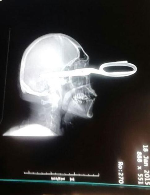Foto: Imagen de la radiografía del cráneo de Jonás Acevedo Monroy con las tijeras visiblemente clavadas. (Fiscalía de Chihuahua)