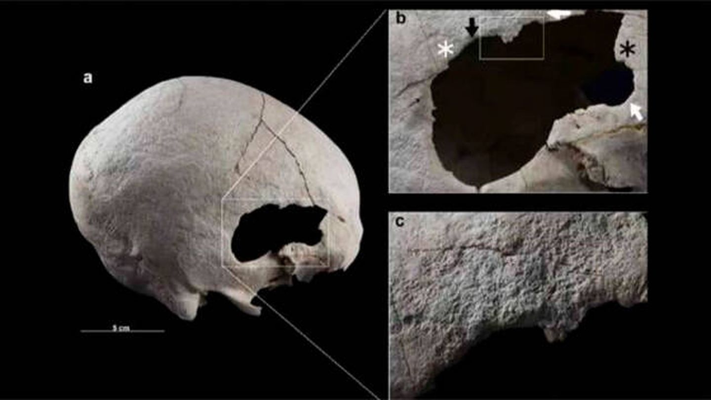 Fotos con los agujeros del cráneo de la mujer de la Edad de Bronce encontrado en Caravaca de la Cruz (Sonia Díaz-Navarro et al.)