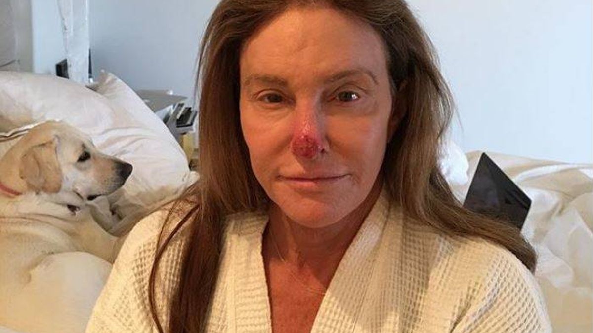 Caitlyn Jenner, operada de cáncer de piel, sube una escalofriante foto a su Instagram