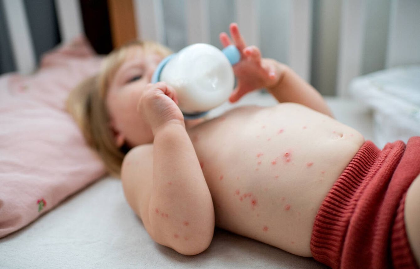 El virus del herpes zóster es el de la varicela, que se suele contraer en la infancia. (iStock)