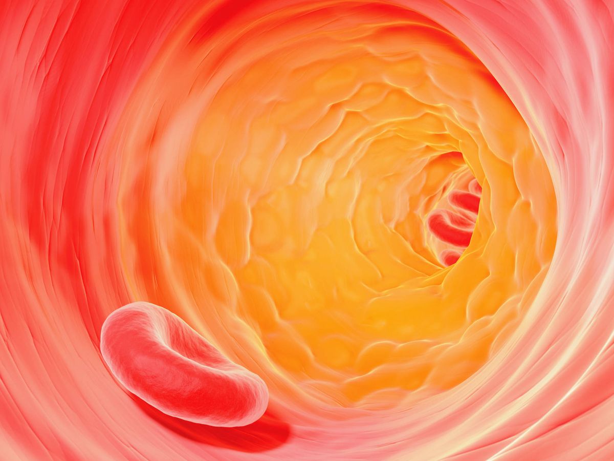 Foto: Placa de colesterol en arteria. (iStock)