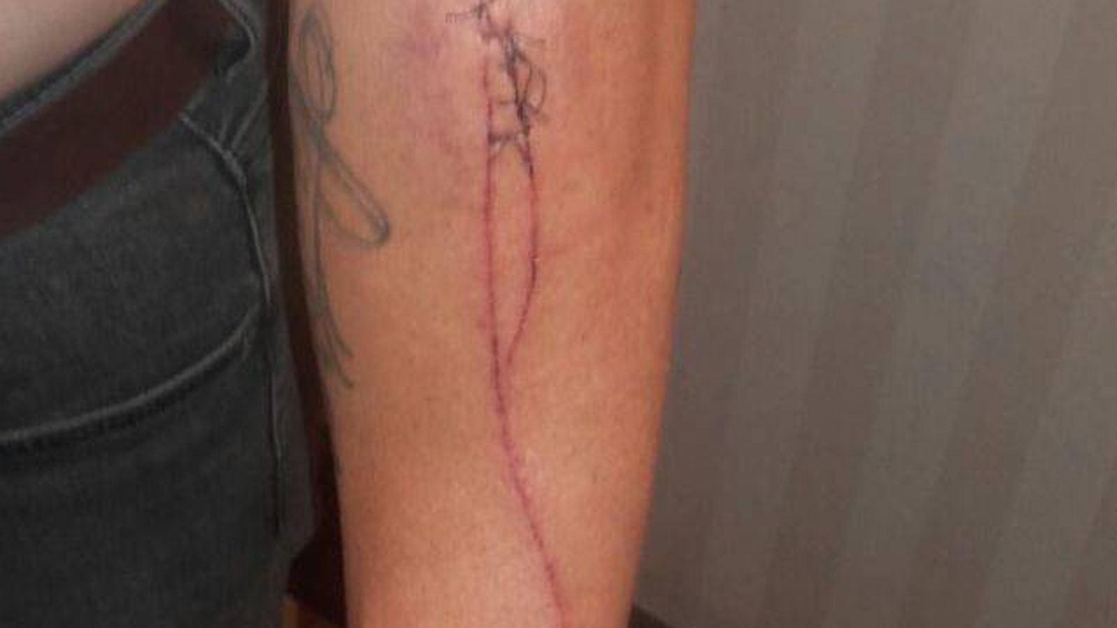 Foto: Una de las heridas de José Guerrero. (Cadena SER) 