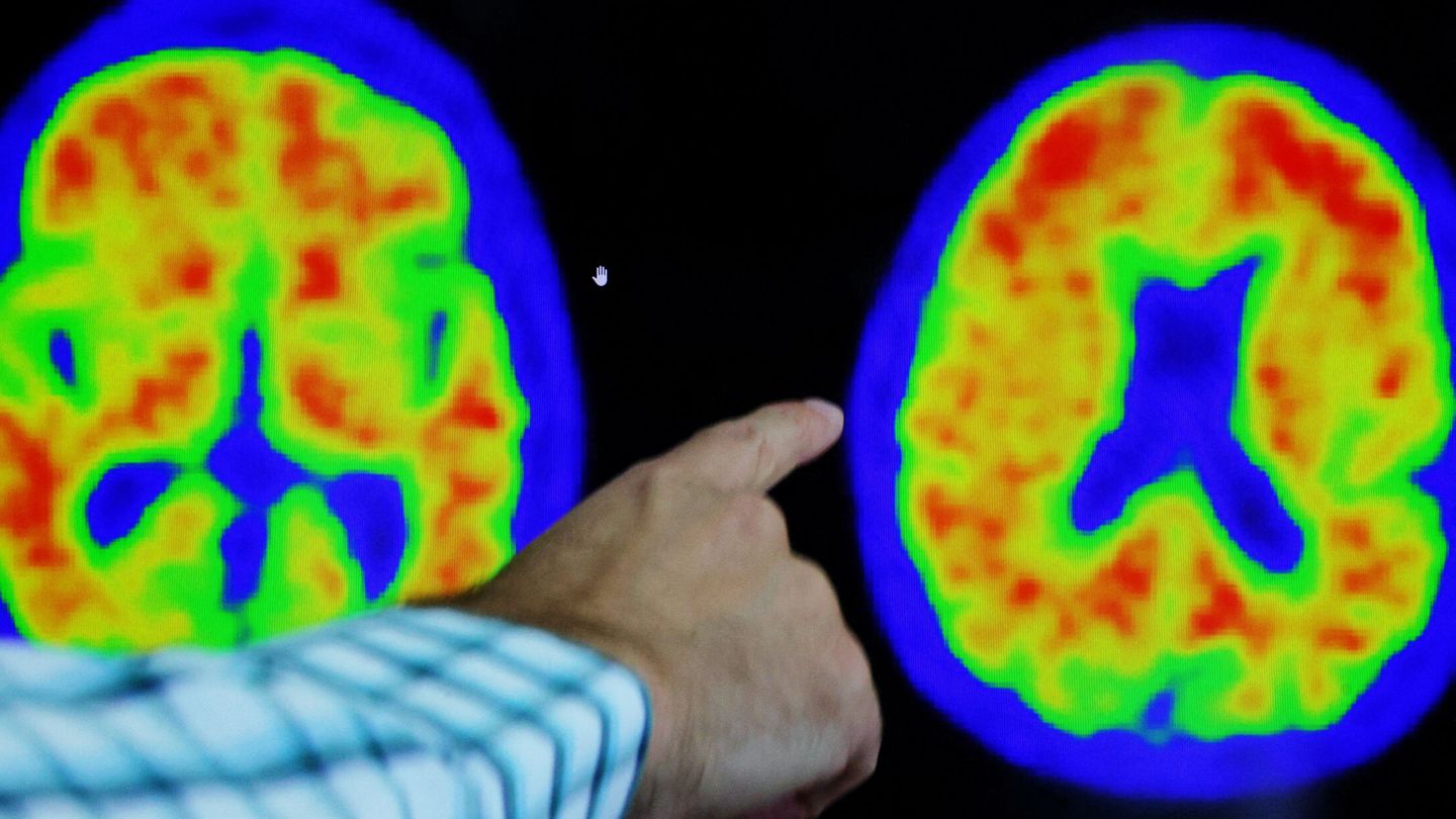 Imagen de cerebros de animales afectados por alzhéimer. (Reuters)