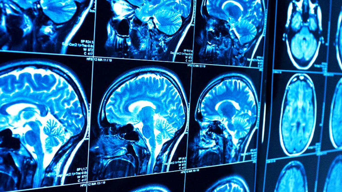 La inflamación cerebral es más habitual de lo que se pensaba en la demencia