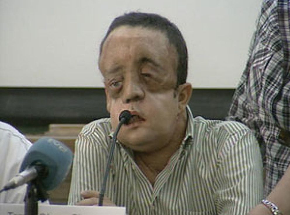 Foto: El segundo trasplantado de cara en España aparece públicamente