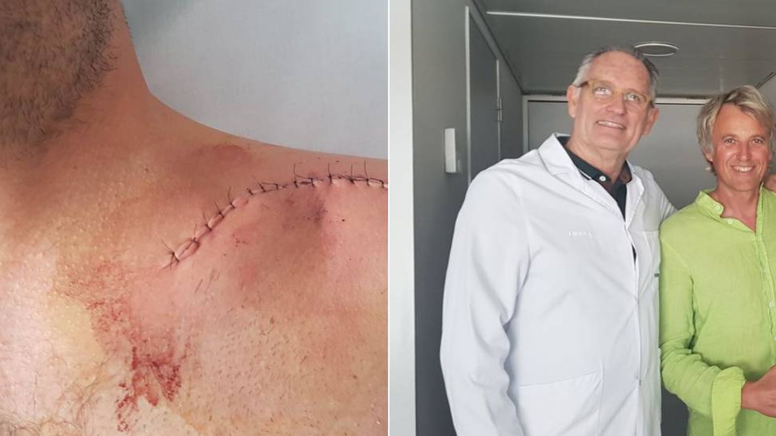 Foto: Jesús Calleja con el doctor Mir y la cicatriz de la operación. (foto jesus calleja)