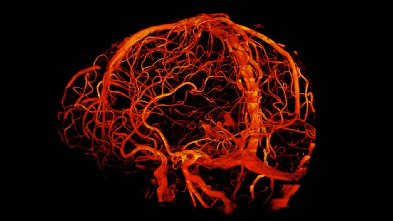 Foto: Resonancia magnética de los vasos sanguíneos del cerebro. (Universidad de Queensland) 