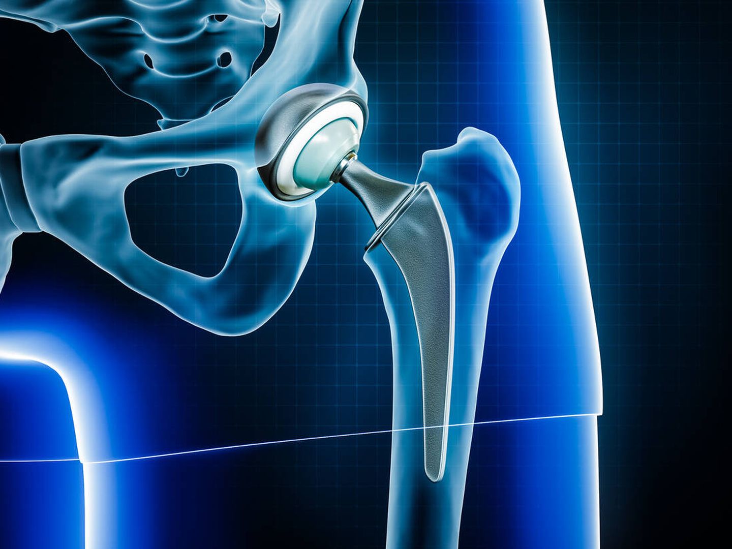 La radiografía muestra la prótesis de cadera. (iStock)