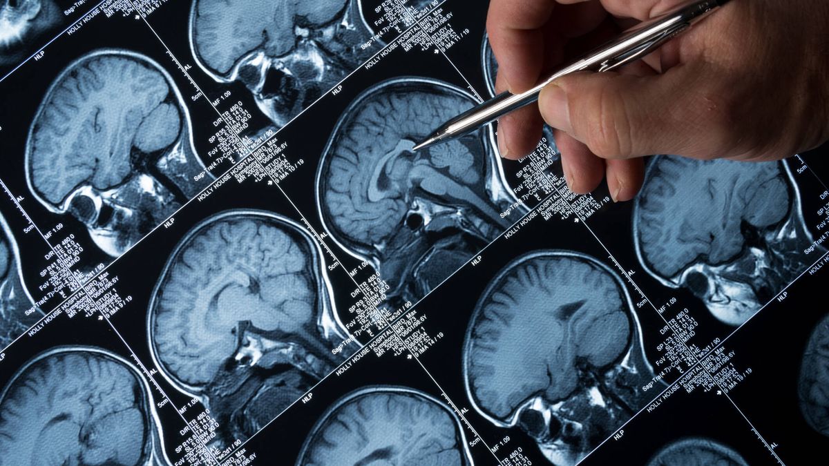 Un innovador fármaco que frena la progresión del alzhéimer confirma su eficacia