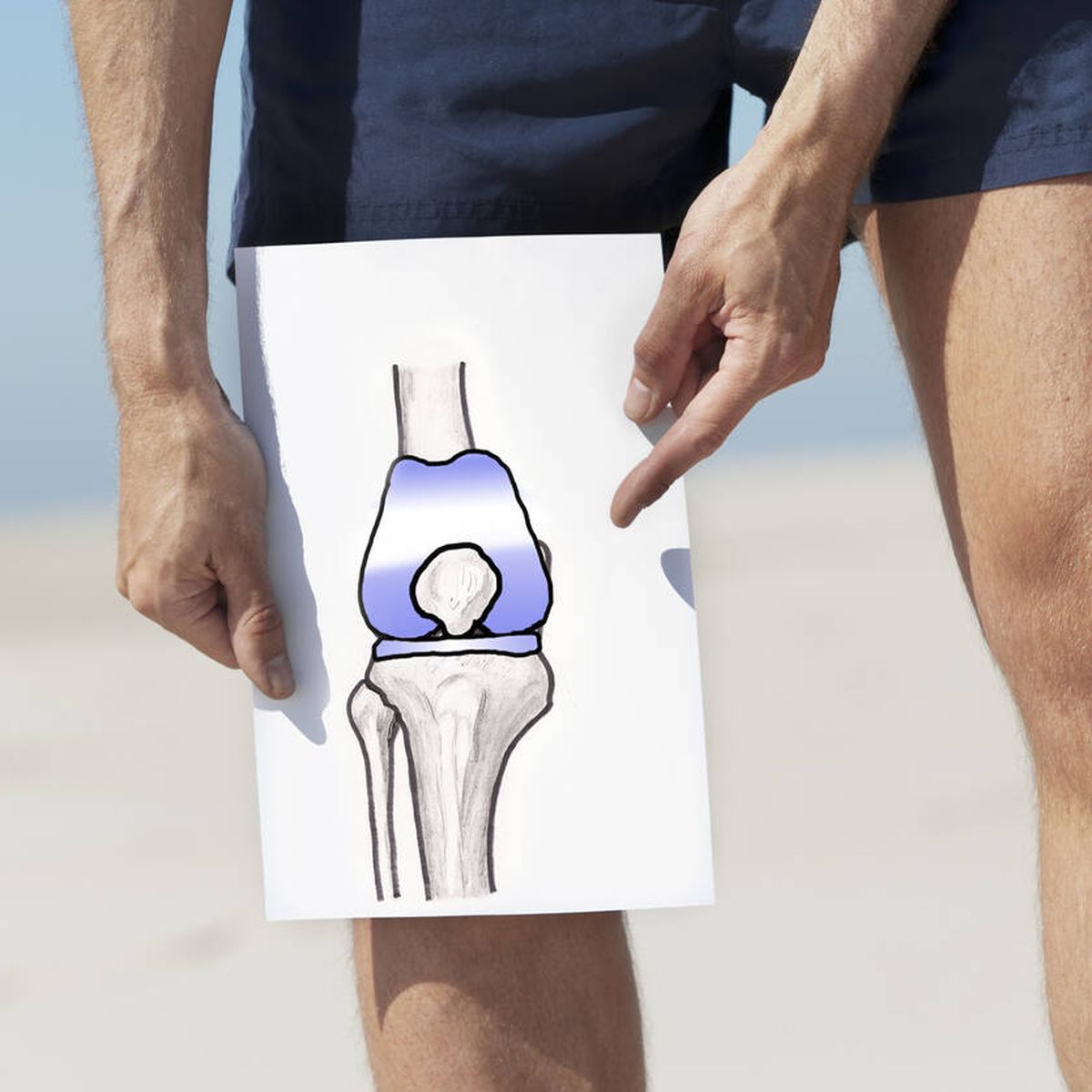 Cuándo operar la artrosis de rodilla?