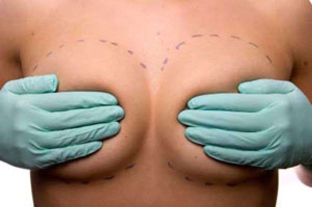 Foto: Mitos y verdades de la mamoplastia según Planas