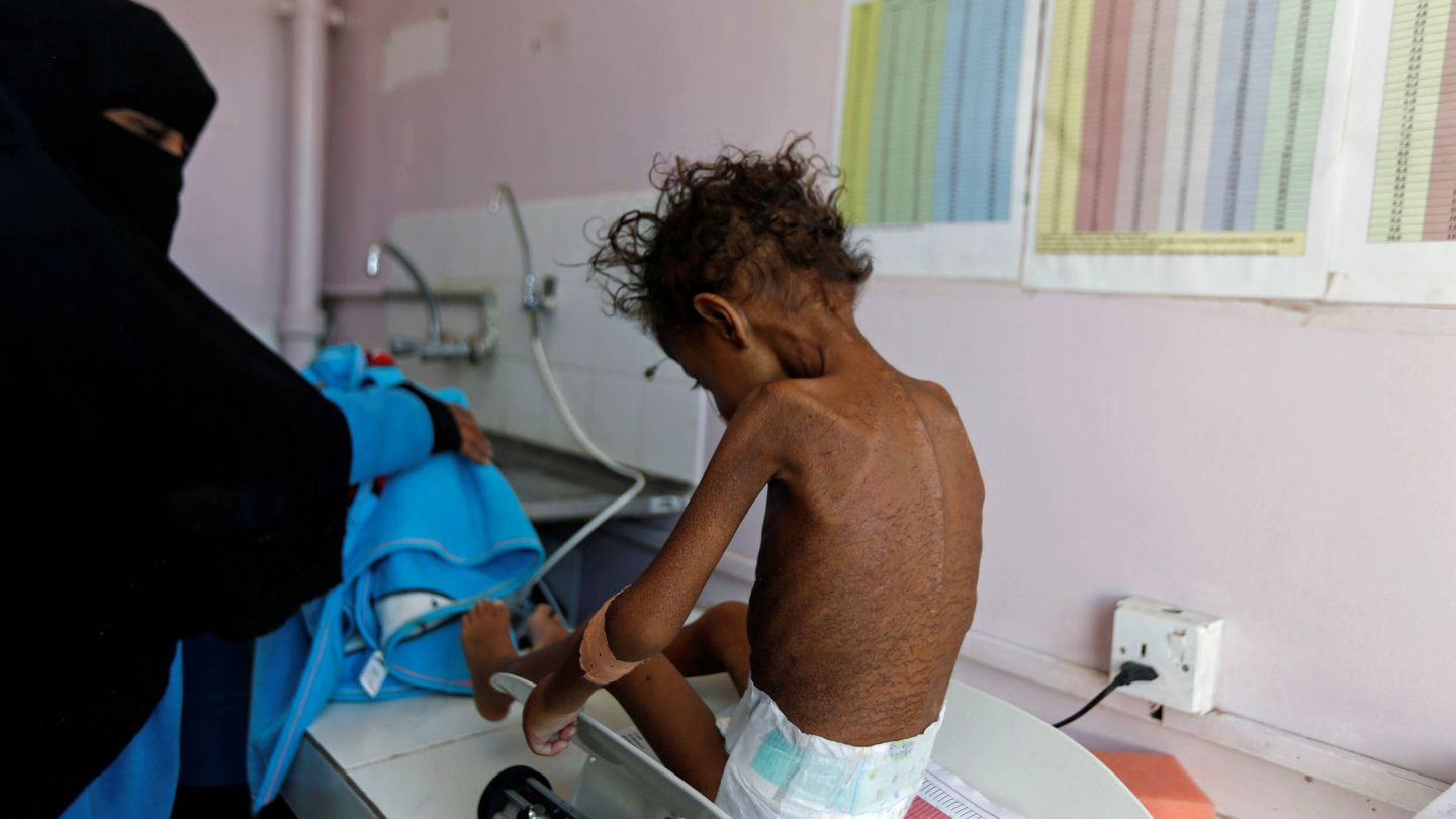 Una mujer observa a su hija, de cinco años, en un centro de tratamiento contra la malnutrición en Saná. (Reuters)