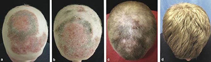 Paciente de 25 años con alopecia universalis y psoriasis a) antes del tratamiento con tofacitinib b) dos meses con terapia c) cinco meses con tratamiento, y d) ocho meses después. (Brett A. King et al.)