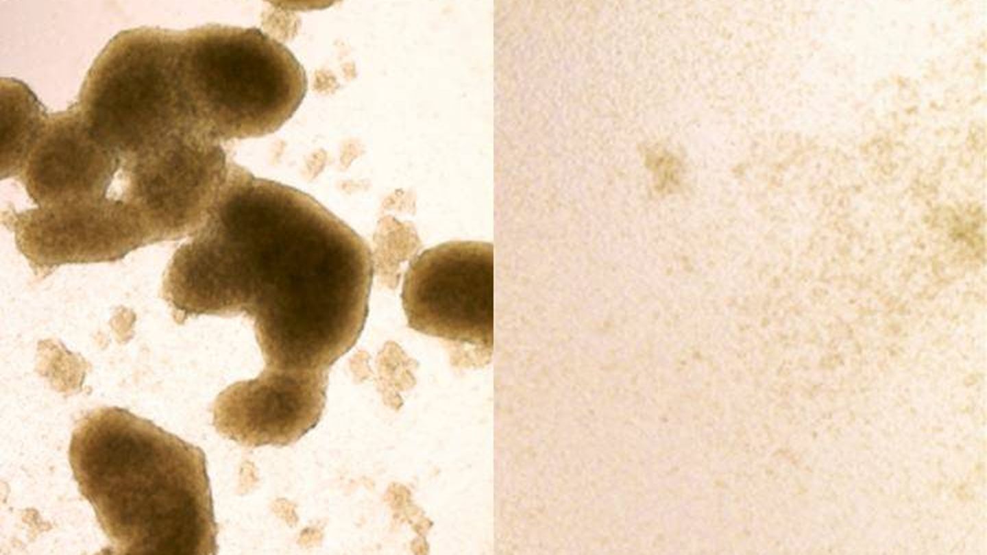 A la izquierda, células madre de glioblastoma; a la derecha, el mismo tejido tras la intervención del Zika. (Zhe Zhu)
