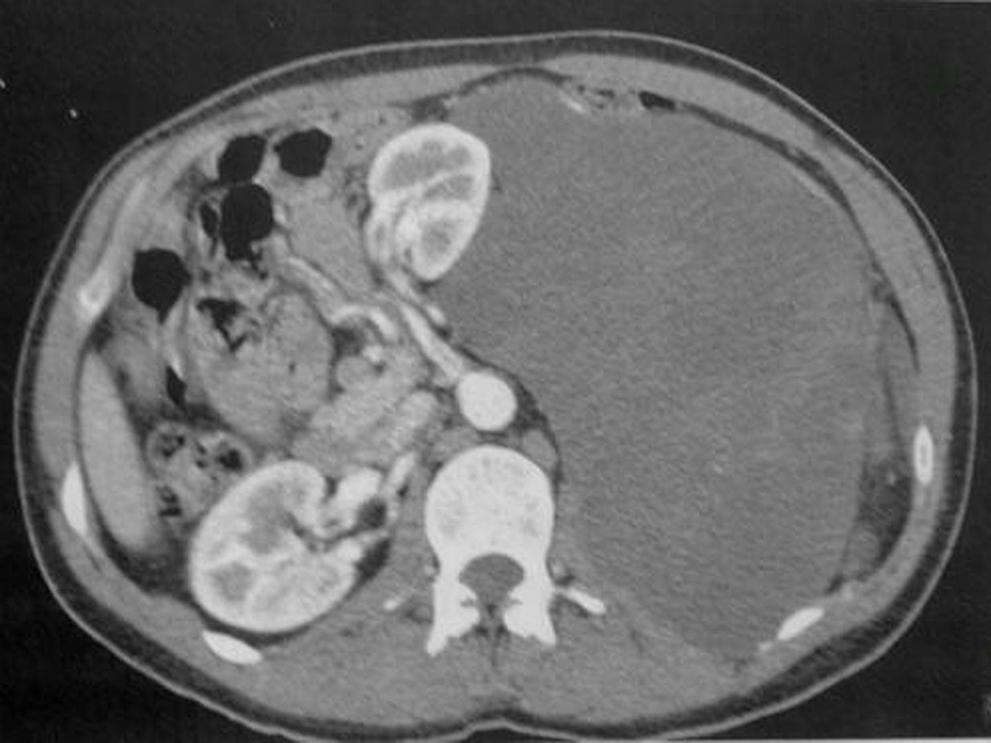 Sarcoma retroperitoneal, de origen en el tejido graso (liposarcoma), que ocupa toda la cavidad abdominal, ha desplazado el riñón izquierdo hacia arriba y roza la arteria aorta. (Foto cedida por el QTI)
