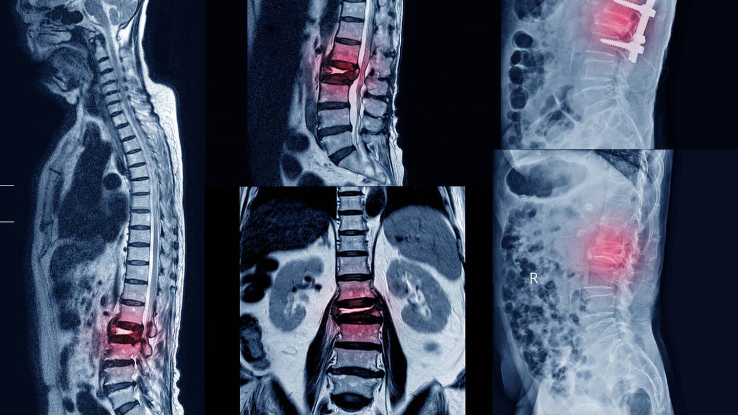 La resonancia magnética muestra fractura vertebral en la zona lumbar. (iStock)