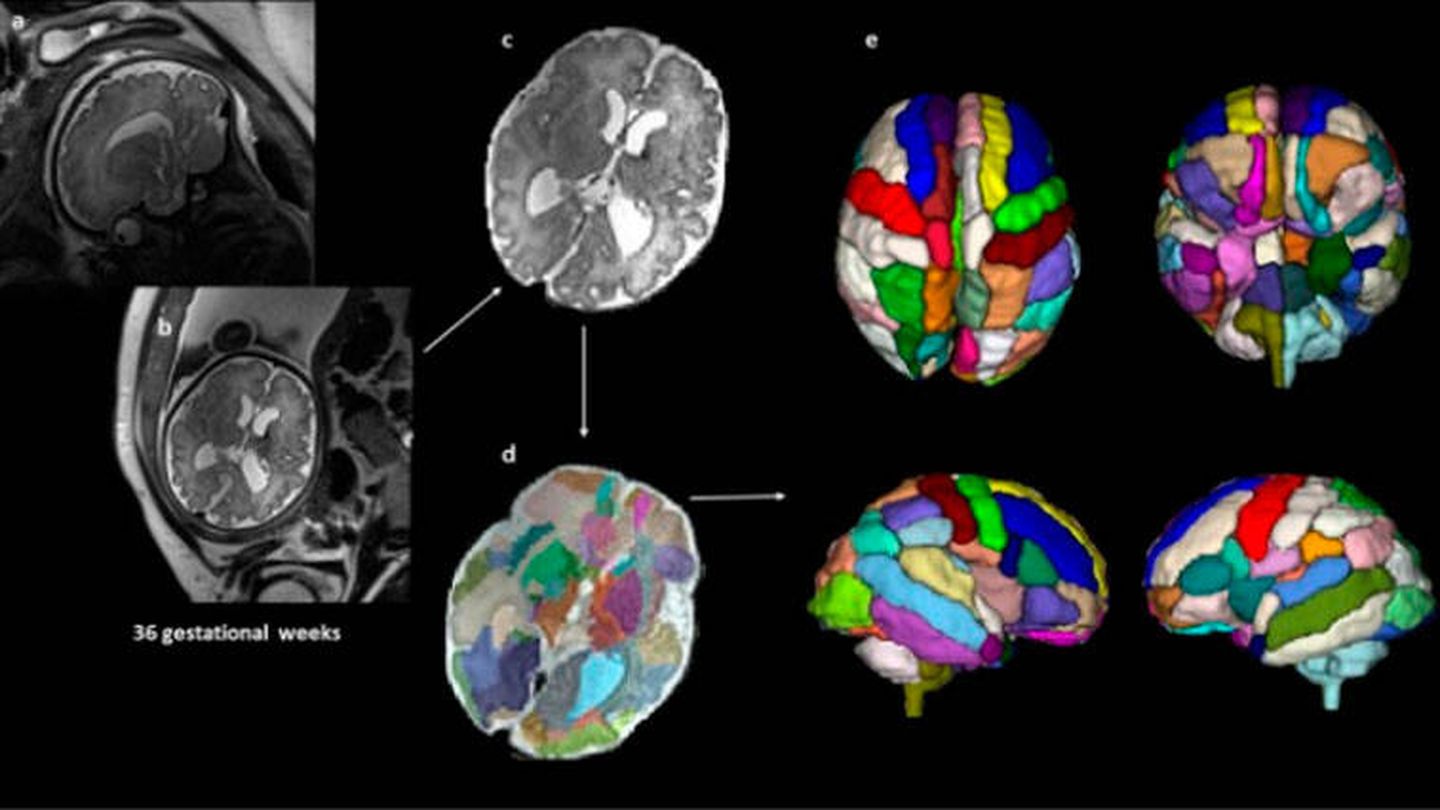 Los escáneres que ayudaron a encontrar las diferencias en el cerebro. (Alpen Ortug y Emi Takahashi/Harvard Medical School)