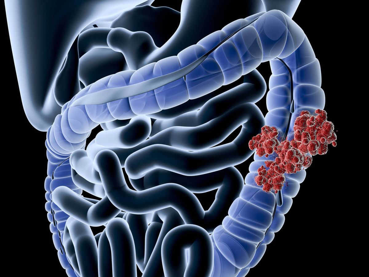 Foto: Ilustración del cáncer de colon. (iStock)