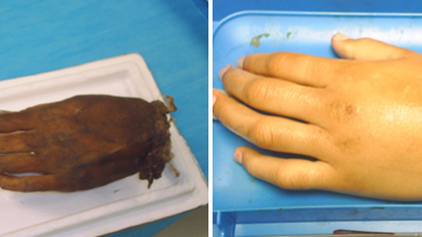 Una mano antes y después del proceso aplicado por el médico forense (D.B)