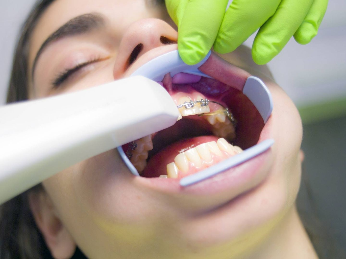 Los dientes pueden volverse sensibles por la presencia de caries y la erosión de las encías (Unsplash)