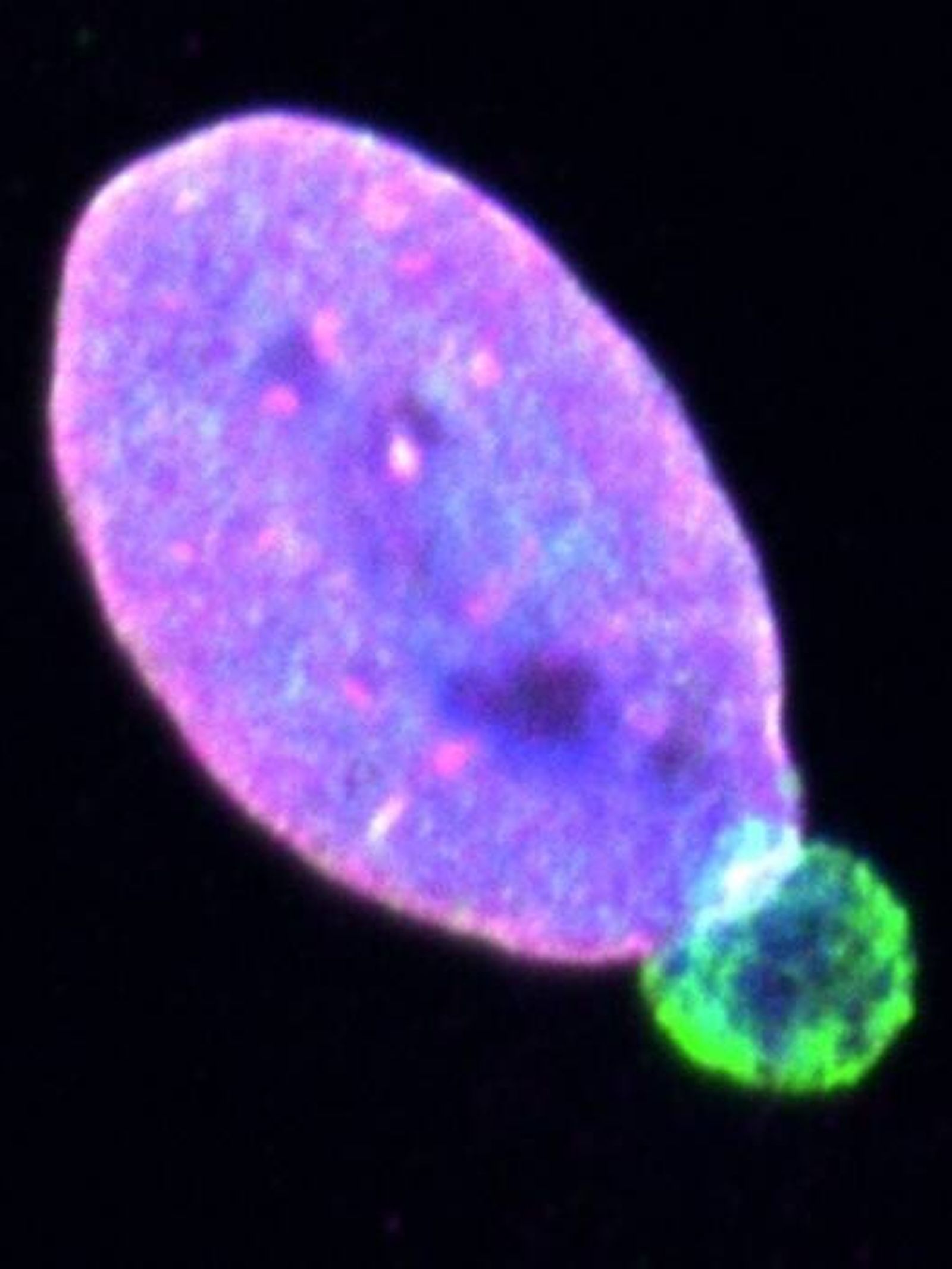 Núcleo de célula de melanoma WM983B con una ampolla de envoltura nuclear teñida para Lamin A/C (verde), Lamin B1 (magenta) y ADN (azul). (Jung García, et al.)
