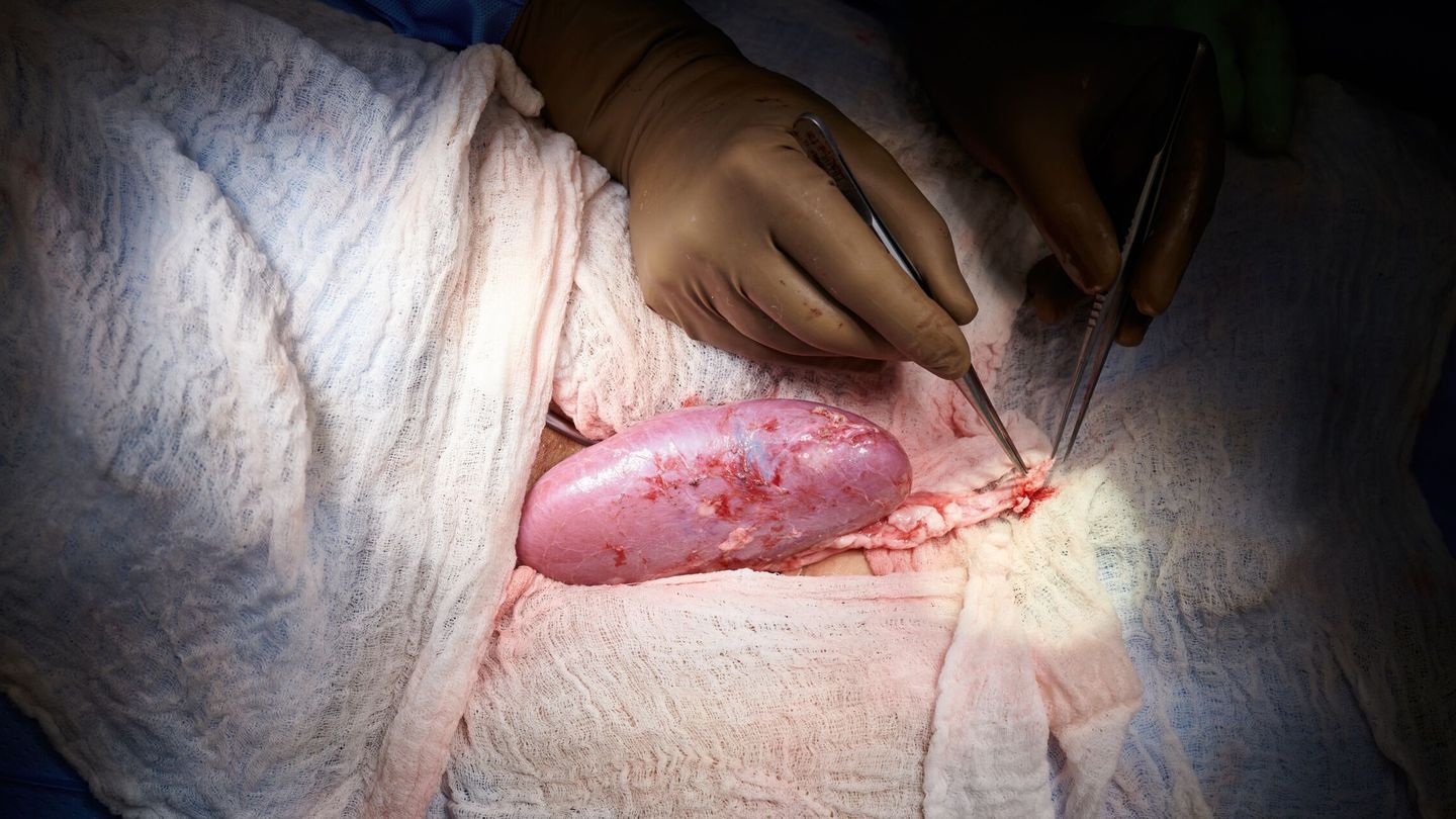 Prueba de trasplante de órgano de cerdo a humano. (EFE/NYU Langone Health/Joe Carrotta)