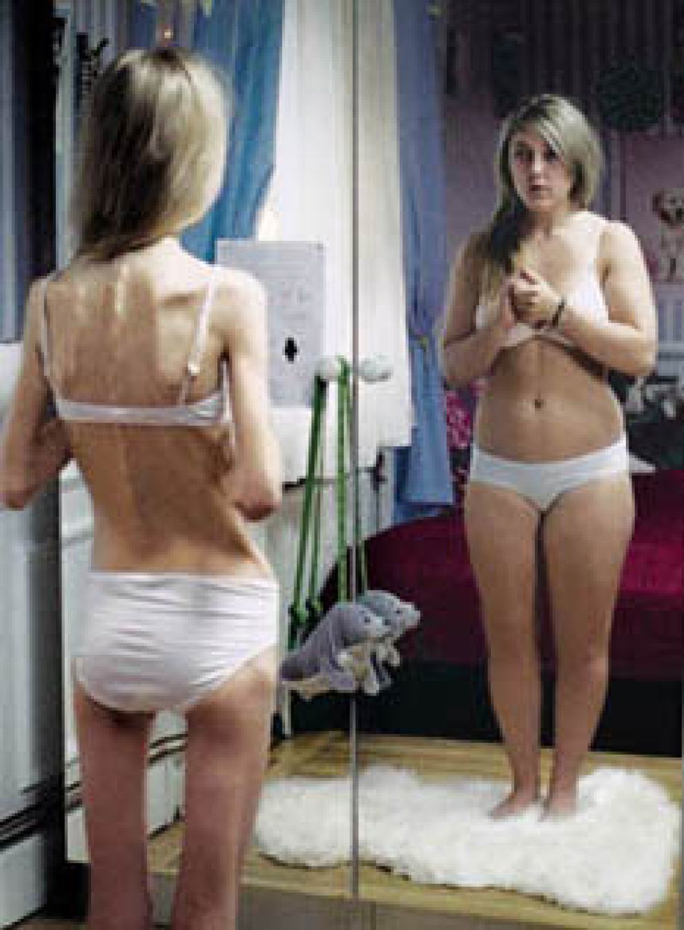 Foto: Una educación hiperprotectora influye en el desarrollo de la anorexia