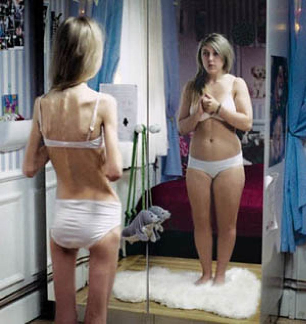 Foto: Guía para reconocer los signos de la bulimia y anorexia